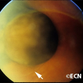 Choroidal melanoma