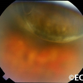 Choroidal melanoma