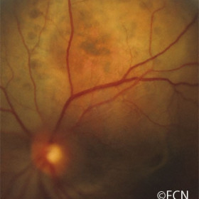 Choroidal metastasis