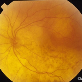 Choroidal metastasis