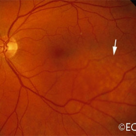 Choroidal hemangioma, circumscribed