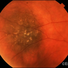 Choroidal Nevus