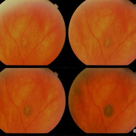 Choroidal nevus