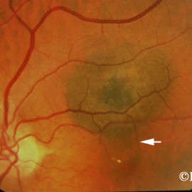 Choroidal Nevus