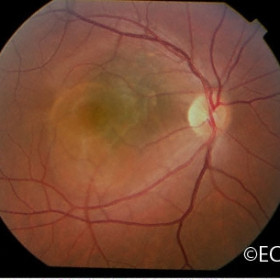 Choroidal Nevus