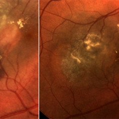 Choroidal Nevus