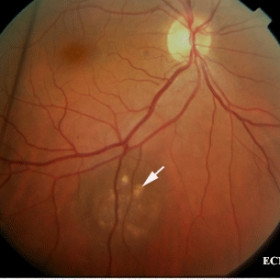 Choroidal nevus