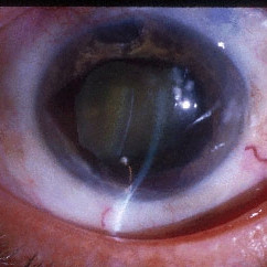 Ciliary Body Melanoma