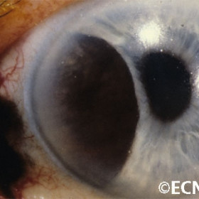 Ciliary body melanoma