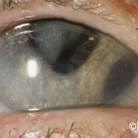 Ciliary body melanoma with iris neovascularization