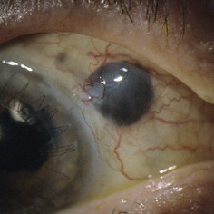 Ciliary body melanoma extension