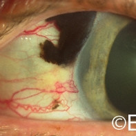 Ciliary body melanoma with extrascleral tumor extension