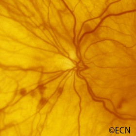 Interferon retinopathy
