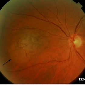 Choroidal melanoma