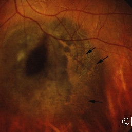 Choroidal melanoma