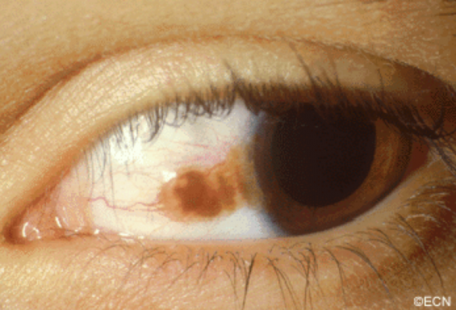A nevus of the conjunctiva
