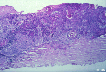 Squamous-Carcinoma-and-Intraepithelial-Neoplasia-of-the-Conjunctiva-6-squamous_diagnosis