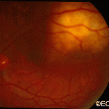 Choroidal metastasis invading central vision