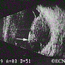 Ultrasound of a collar-button shaped Choroidal Melanoma