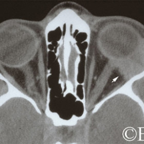 Adenoid cystic carcinoma of the lacrimal gland