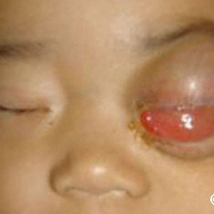 Advanced retinoblastoma