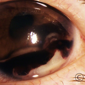 Anterior segmentmet breast