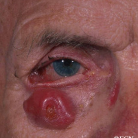Basal cell carcinoma