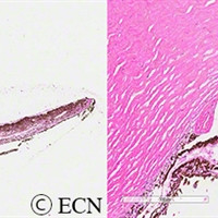 Retinoblastoma associated iris neovascularization
