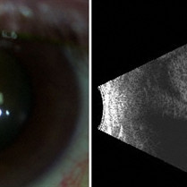 Choroidal Melanoma