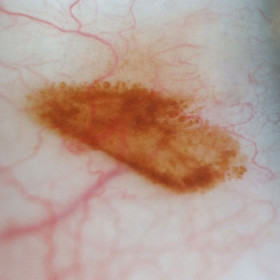 Conjunctival Nevus