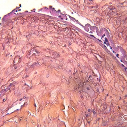 Iris Melanocytoma