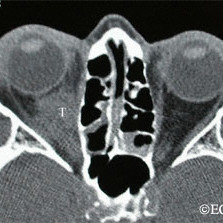 Orbital lymphoma before radiation therapy (T)