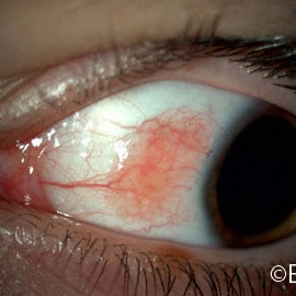 Conjunctival Nevus