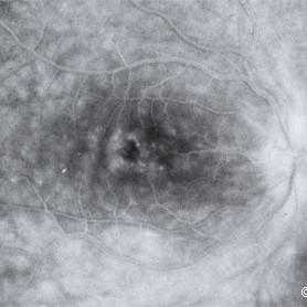 Cystoid macular edema