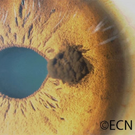 Iris Melanocytoma