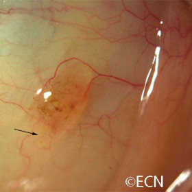 Conjunctival nevus