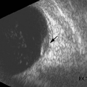 Choroidal melanoma