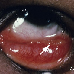 Conjunctival sarciod granuloma