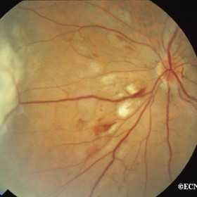 Early radiation retinopathy
