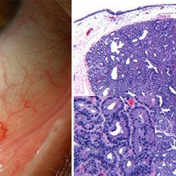 Lacrimal Gland Choristoma
