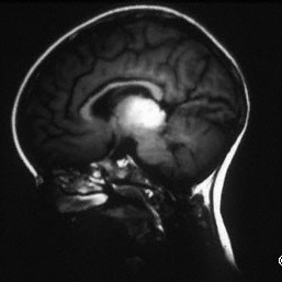 Pinealoma associated with a bilateral retinoblastoma
