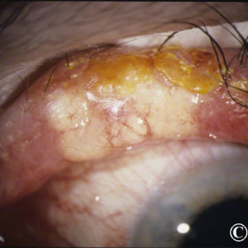 Sebaceous carcinoma in the upper eyelid