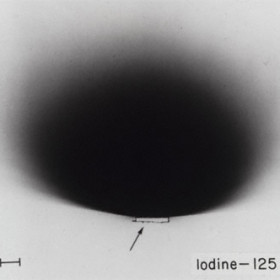 Plaque block radiation (black) on x-ray film