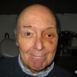 Temporary prosthesis