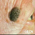 Seborrheic keratosis