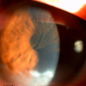 Corneal Melanoma