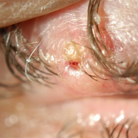 Squamous Carcinoma of the Eyelid