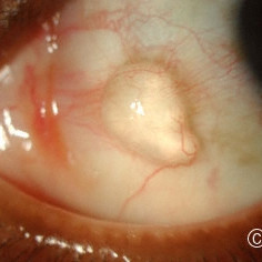 Epibulbar Conjunctival Cyst