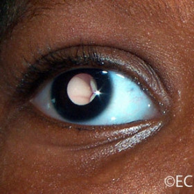 Retinoblastoma Leukocoria