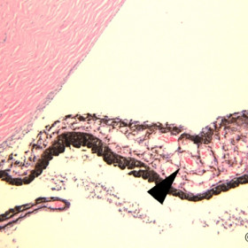Retinoblastoma